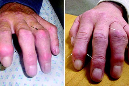 Đa xơ cứng - Hình ảnh minh họa